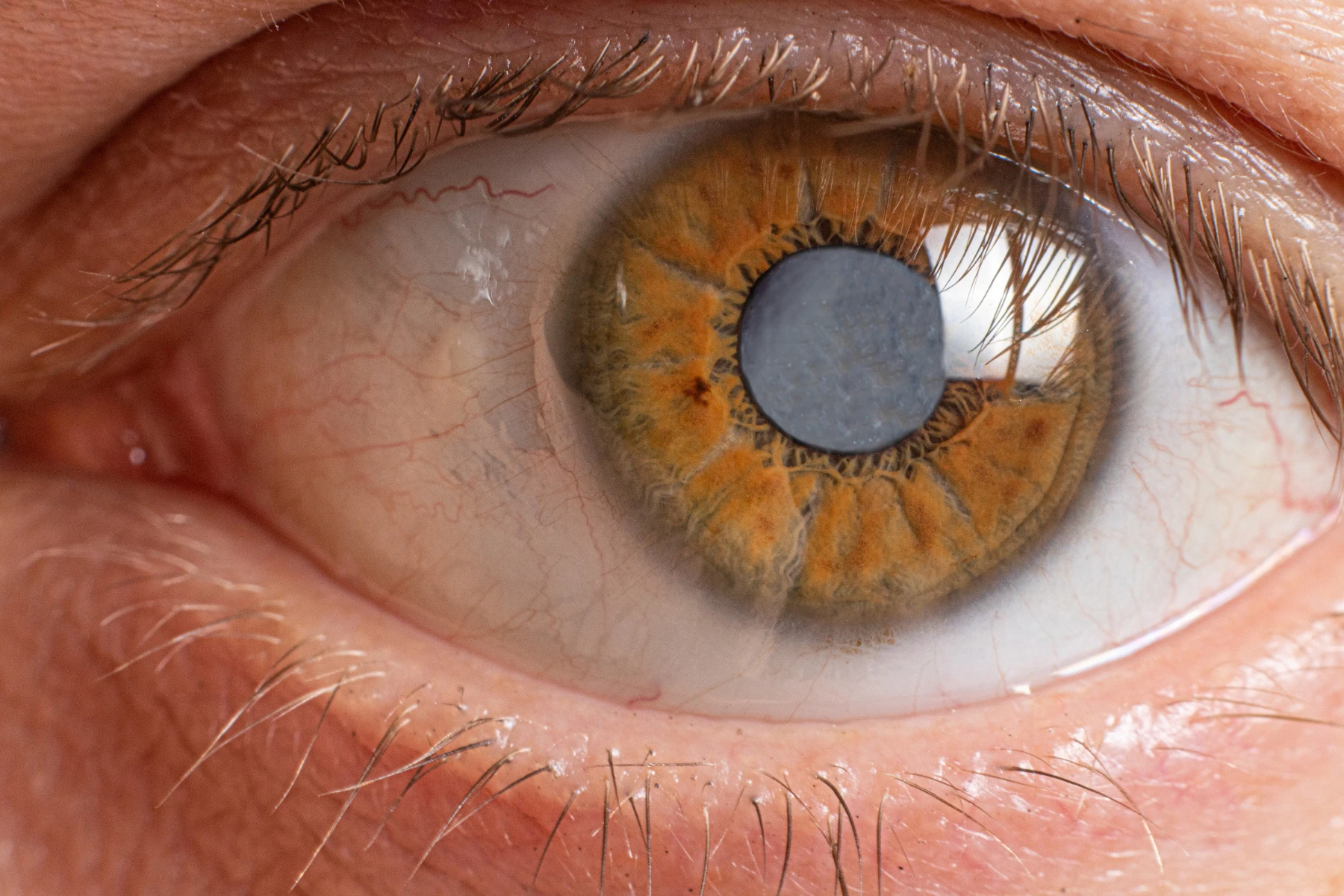 Cataract1