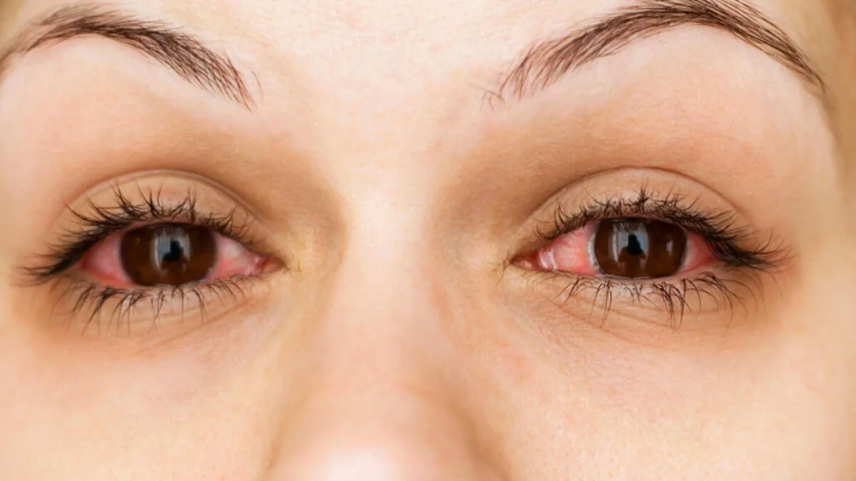 pink_eyes_examination_at_lynbrook_optical